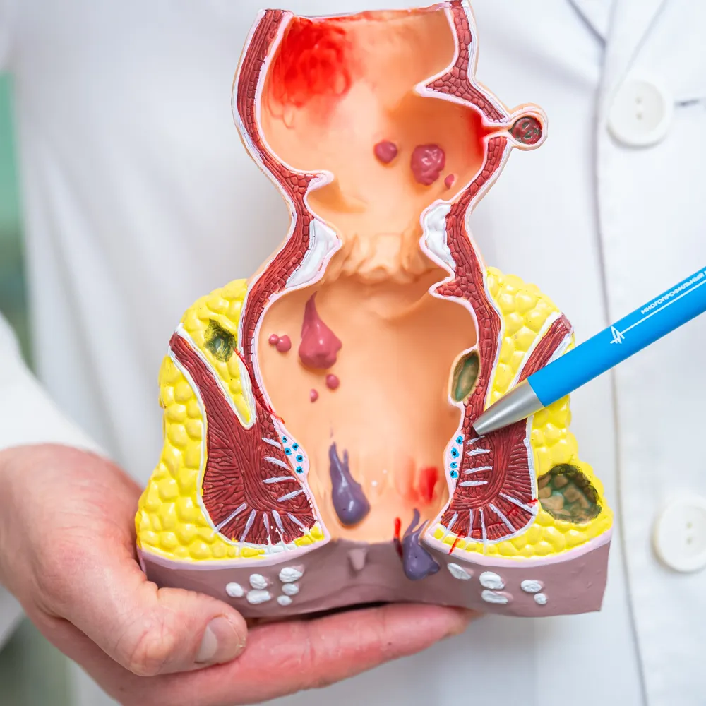 Геморрой Геморрой