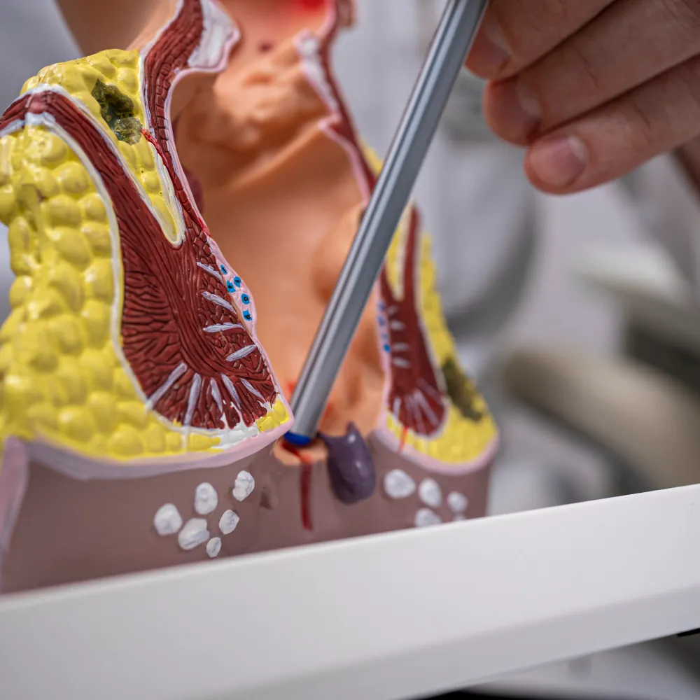 Анальная трещина Анальная трещина